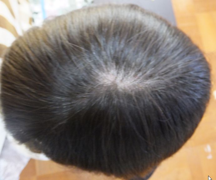 haru黒髪スカルプ使用前の白髪状況（頭頂部）
